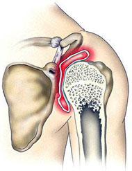 Симптомы и лечение артроза плечевого сустава